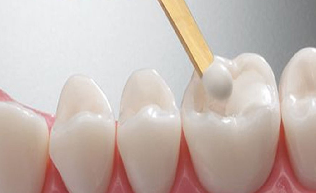 Cavity Treatment & Fillings